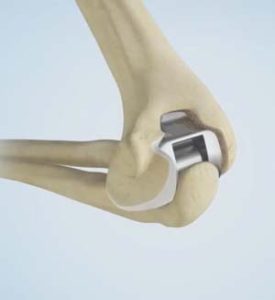 متخصص جراحی آرتروز
