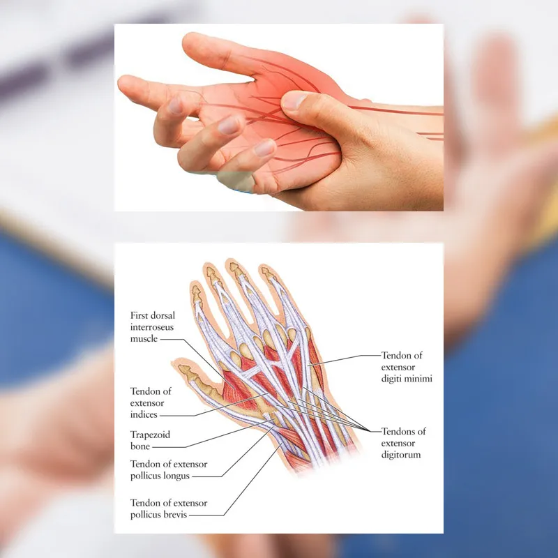 عمل تاندون مچ دست