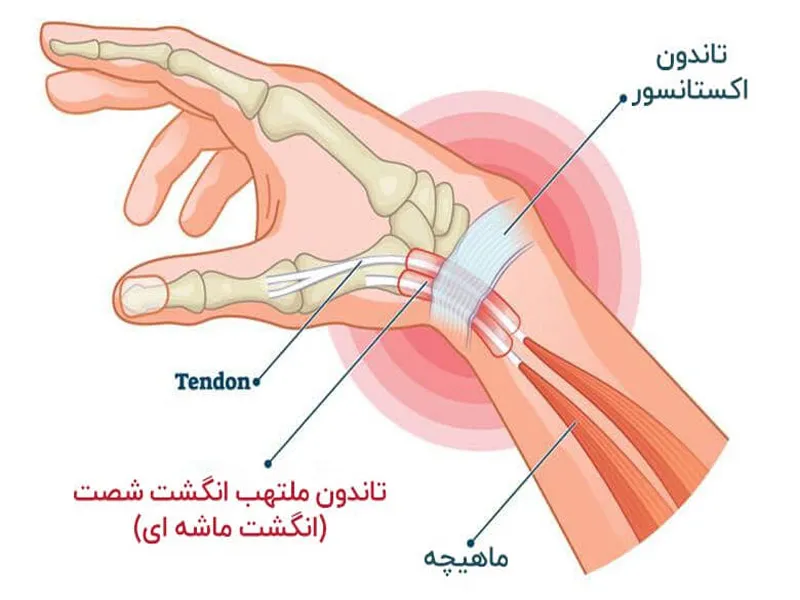 دلایل نیاز به عمل جراحی تاندون مچ دست