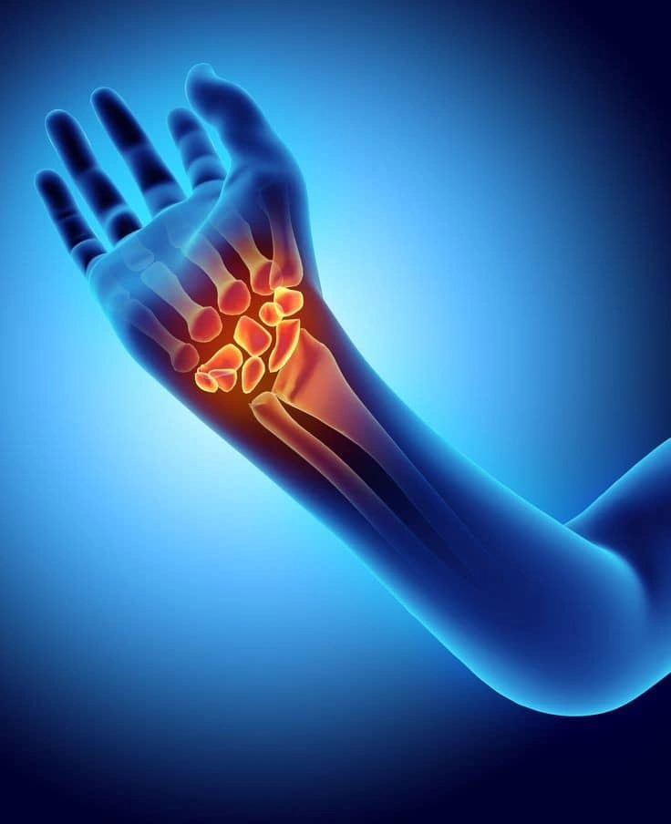 علائم آسیب دیدگی رباط اسکافولونات در مچ دست