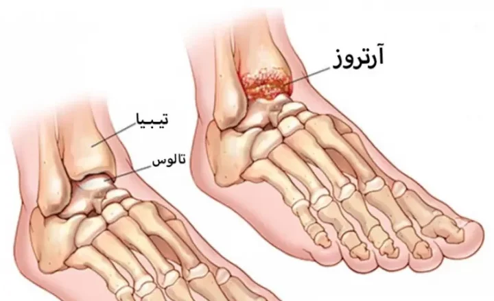 علائم آرتروز پا