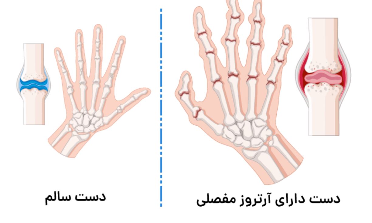علائم آرتروز دست راست