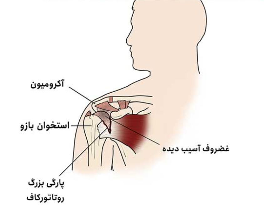 آرتروز شانه راست