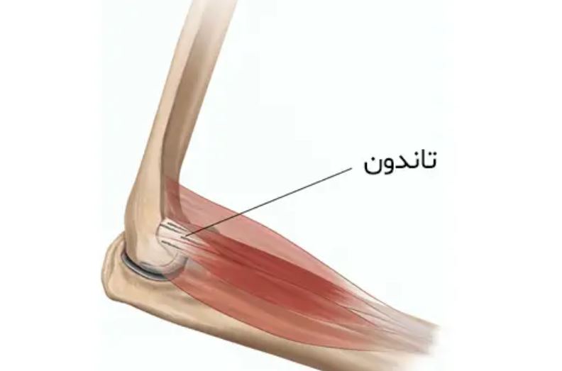 پارگی تاندون آرنج