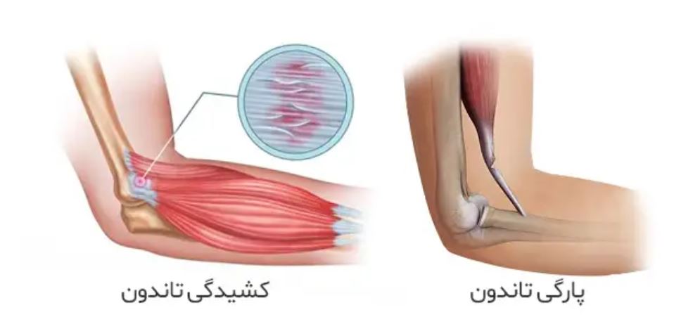 پارگی تاندون آرنج