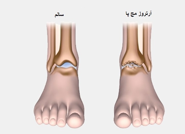 علائم آرتروز پا