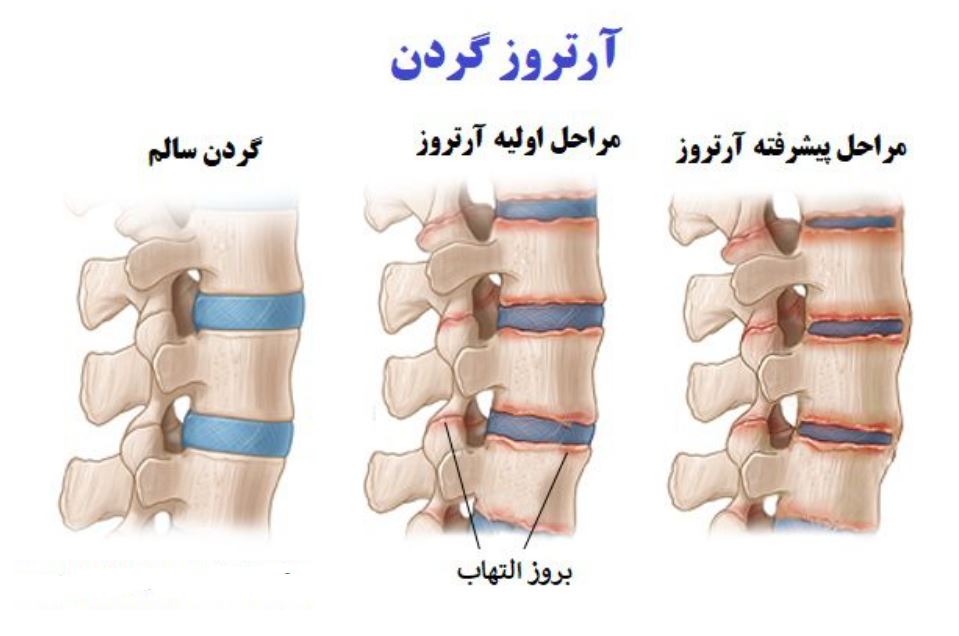 آرتروز گردن در جوانی