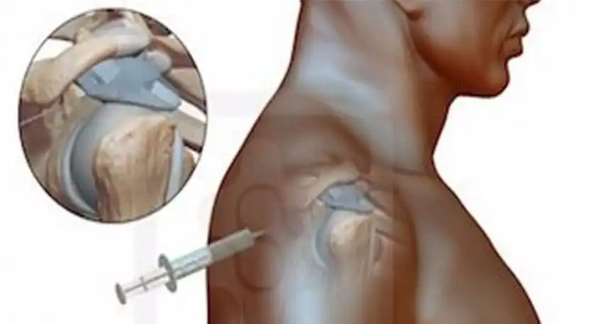 تزریق ژل در شانه منجمد