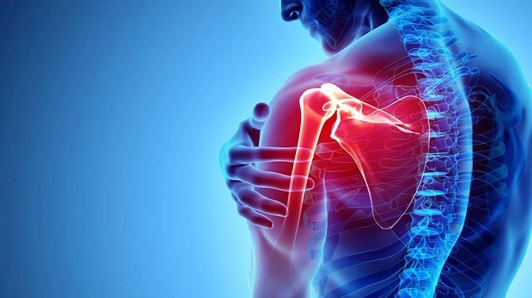 علائم پارگی تاندون شانه