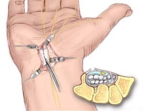 عمل اندوسکوپیک مچ دست cts